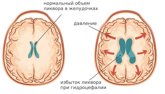 Внутричерепное давление – это сила, с которой мозг давит на стенки черепа