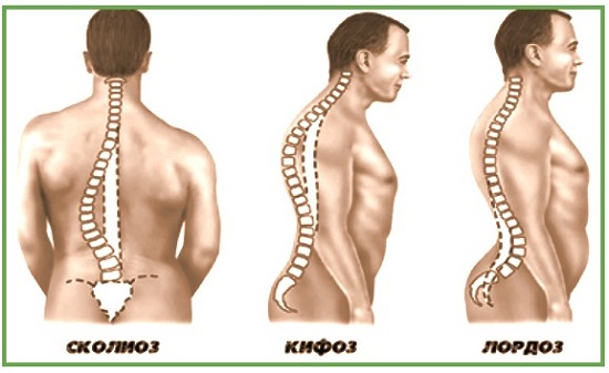 Причины мышечных болей в спине