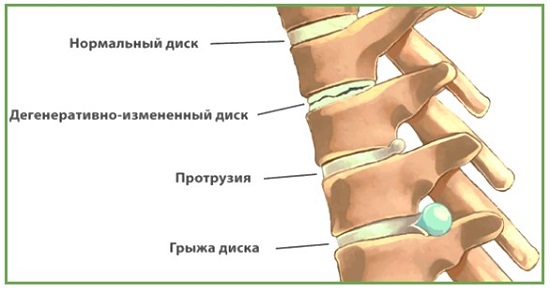 Боль в мышцах спины 