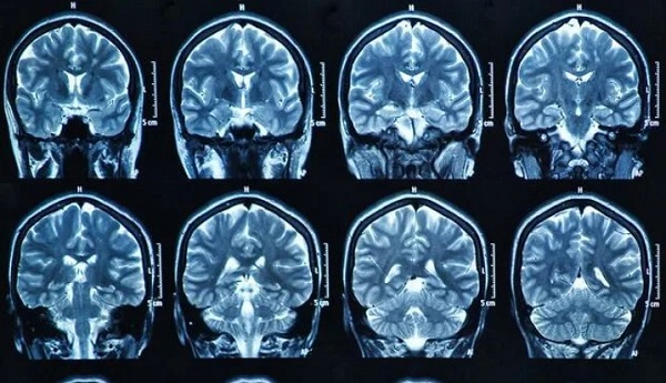 Инсульт на МРТ головного мозга