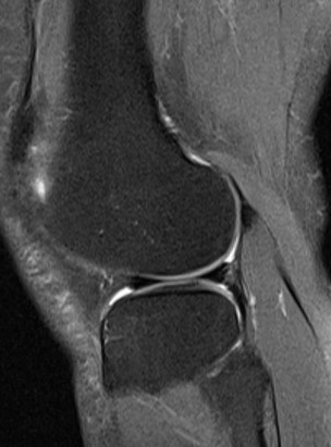 Разрыв мениска коленного сустава на МРТ
