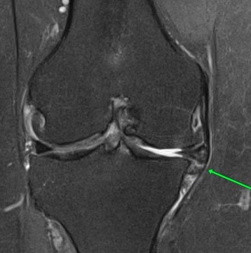 Разрыв мениска коленного сустава на МРТ