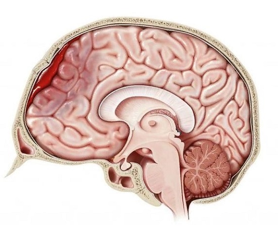 Операции на головном мозге могут быть плановые и экстренные